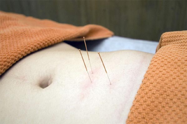 Acupuncture Therapy