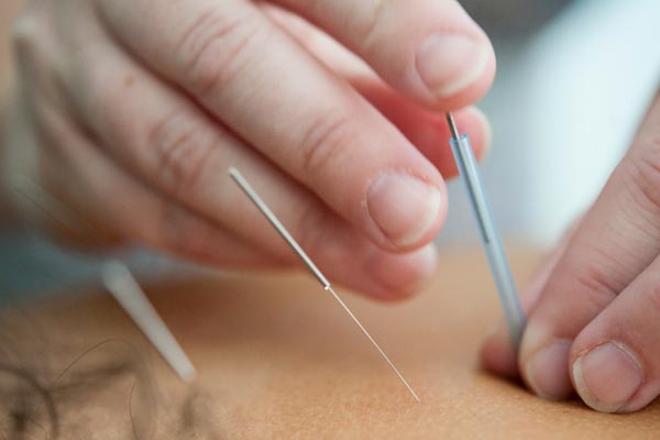 Acupuncture Therapy