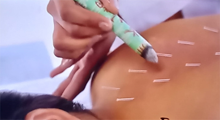 CUPPING THERAPY