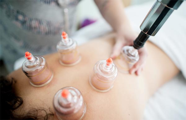 Cupping Therapy