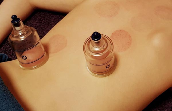 Cupping Therapy